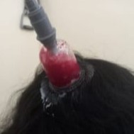 humera jabeen head hijama